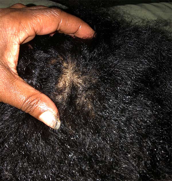 Can Black People Get Lice In Their Hair